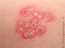 Healing herpetic sores