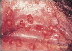 labialherpes