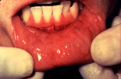 labialmucosaherpes